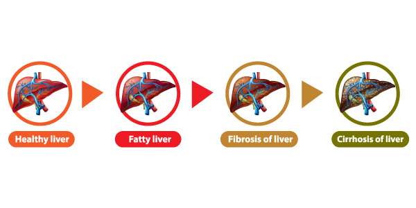 Liver Transplant Cost In India, Functions Of the Liver, Types Of Liver Transplants,  Advantages Of A Liver Transplant, Hospitals for Liver Transplant in India, Risks Associated With Liver Transplant Treatment, Success Rate Of Liver Transplants In India, Questions About Liver Transplants In India