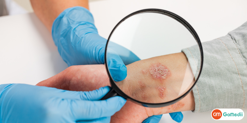 Psoriasis Treatment in India