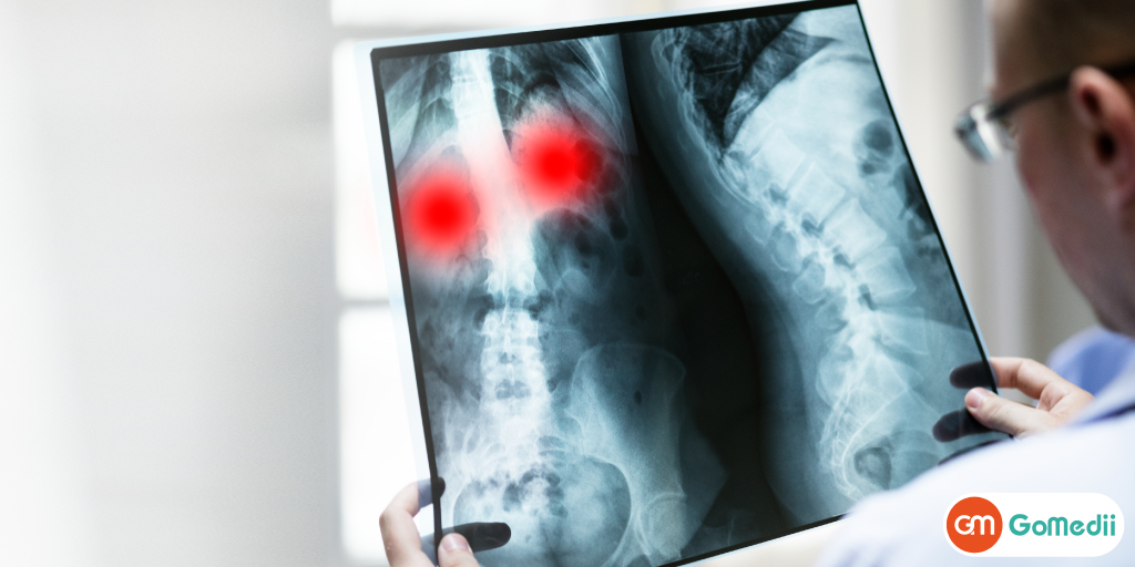 Where to Get Spinal Tuberculosis Treatment in India
