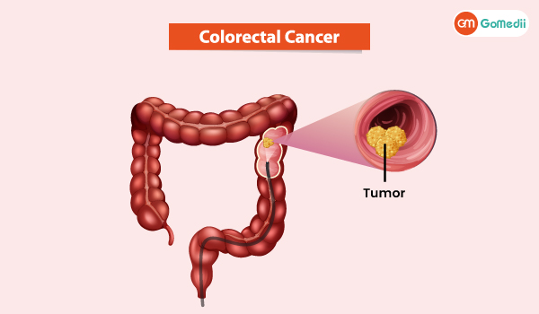 Colorectal Surgery in India, Colorectal Surgery, Hospitals for Colorectal Surgery in India, Cost of Colorectal Surgery in India, Tests Before Colorectal Surgery