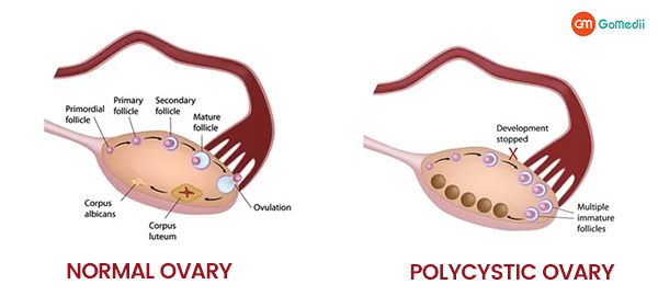 PCOS treatment in India with GoMedii
