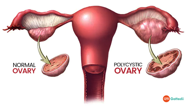 PCOS treatment in India