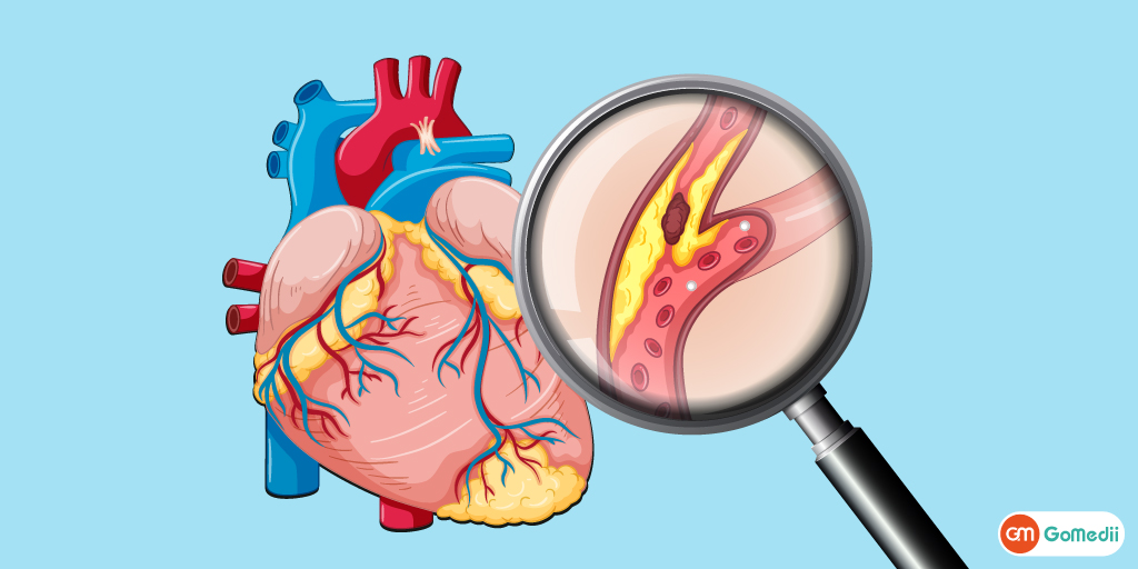 Arteriosclerosis Treatment In India, Types Of Arteriosclerosis, Causes Of Arteriosclerosis, Signs And Symptoms Of Arteriosclerosis, Risk Factors With Arteriosclerosis, Diagnose Of Arteriosclerosis, Cost Of Arteriosclerosis Treatment in India, Hospitals For Arteriosclerosis Treatment in India