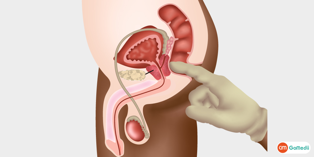 Testicular Torsion Treatment in India, Testicular Torsion, Symptoms Of Testicular Torsion, Sign Of Testicular Torsion, Cause Of Testicular Torsion, Risk Factors Of Testicular Torsion, Complications Of Testicular Torsion, Hospitals For Testicular Torsion Treatment In India