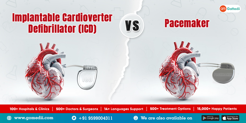 Implantable Cardioverter Defibrillator (ICD) Vs Pacemaker - GoMedii