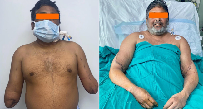 The man who lost his hands in a train accident has got a bilateral hand transplant - GoMedii