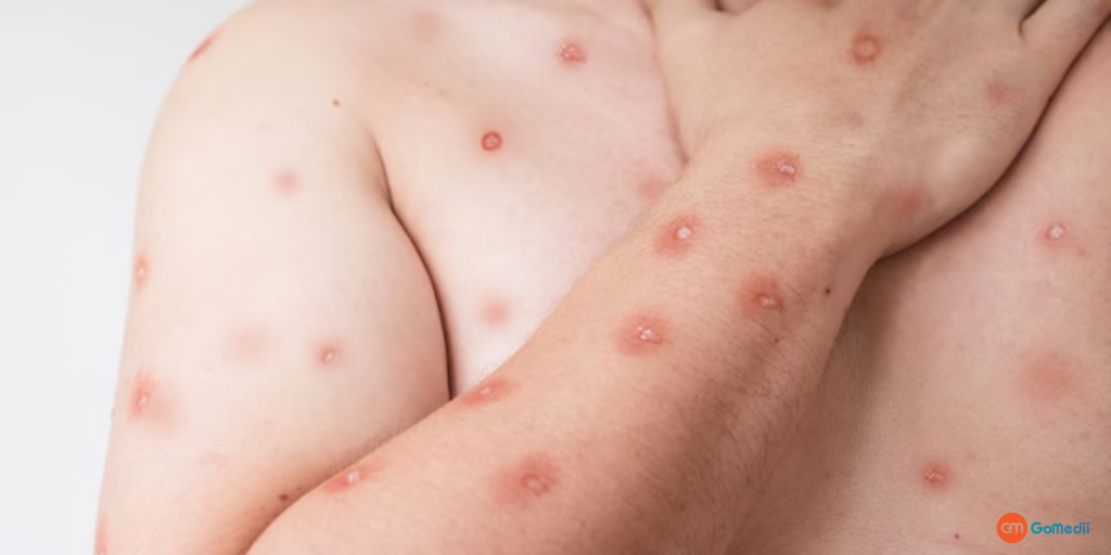 WHO Approves First-Ever Mpox Diagnostic Test Worldwide