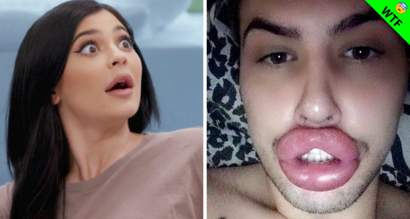 Labios de hombre obsesionado con Kylie están a punto de explotar