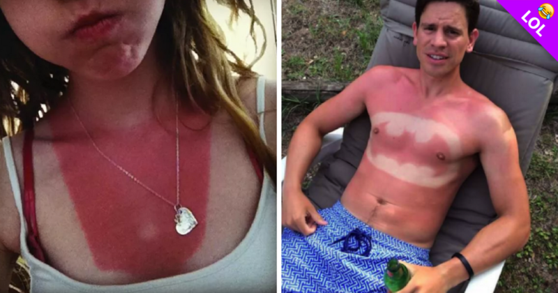 10 personas que se broncearon de más