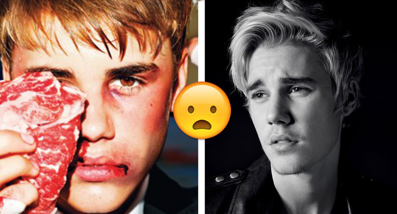 ¡OMG Justin Bieber herido después de un juego!