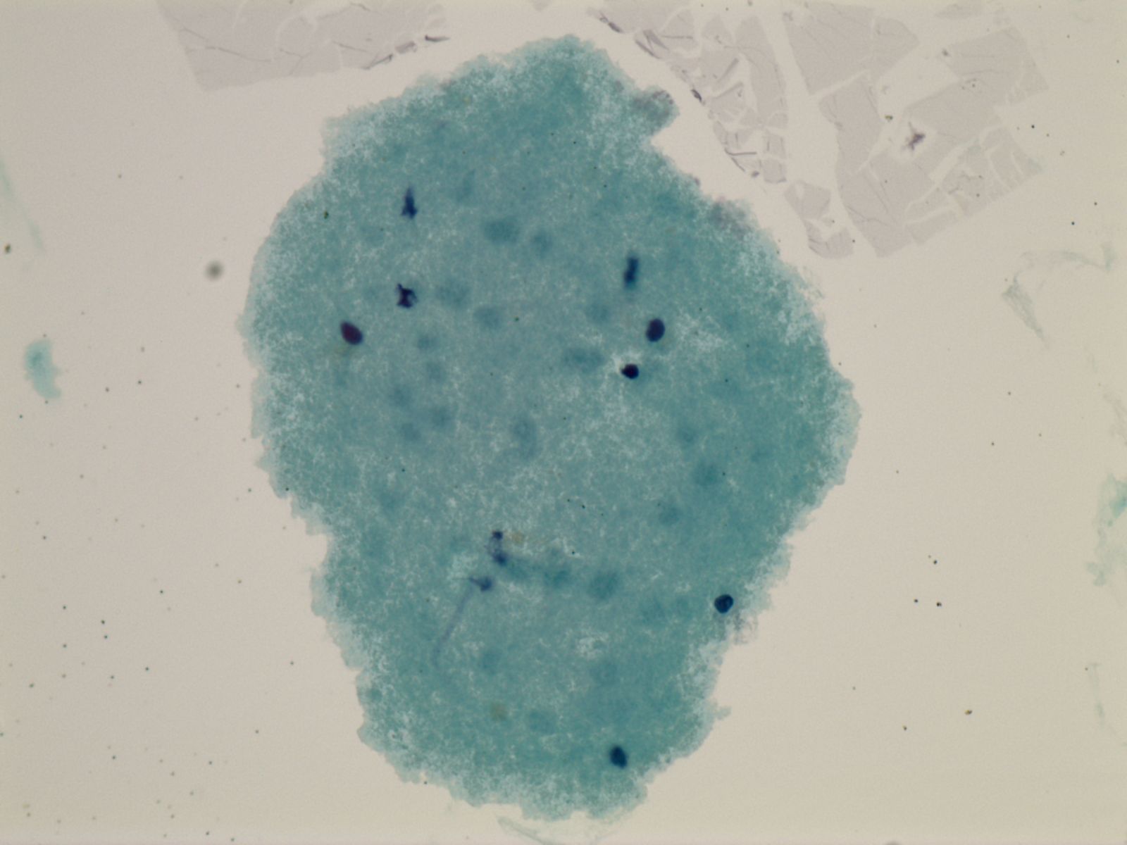 Cerebrospinal fluid cytology specimen.