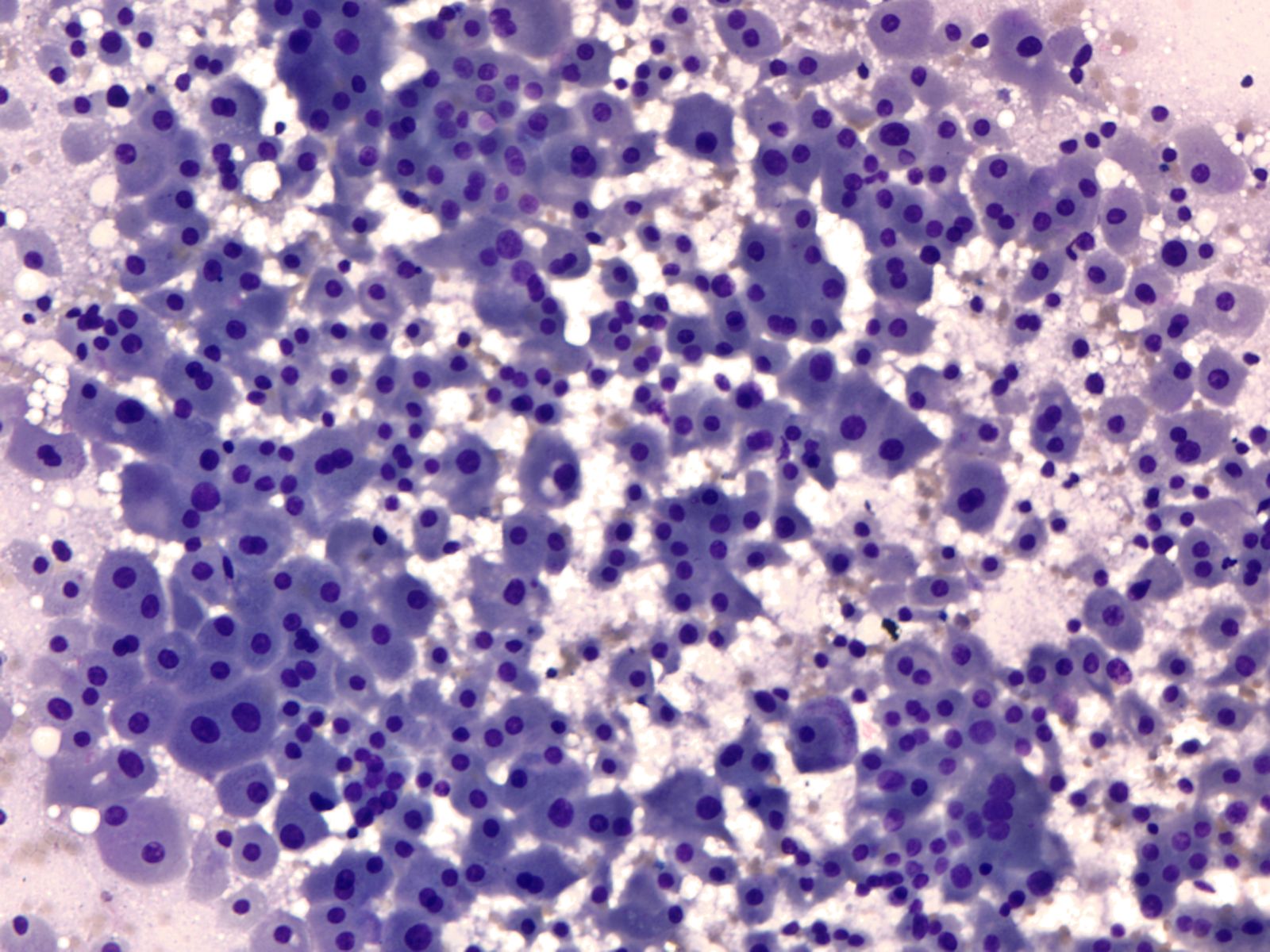 Fine needle aspirate of a 3.2 cm renal mass.
