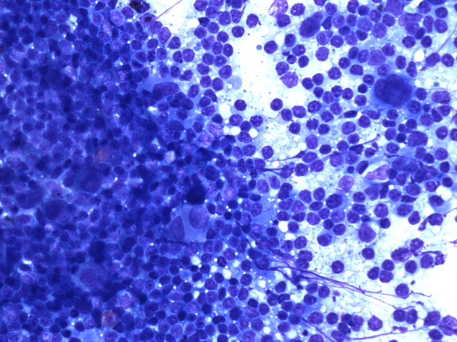 Fine needle aspirate of an axillary lymph node.
