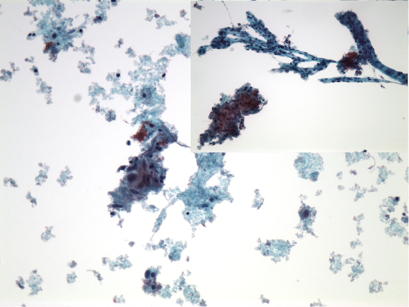CNS cytology specimen with an inset showing an additional microscopic field.