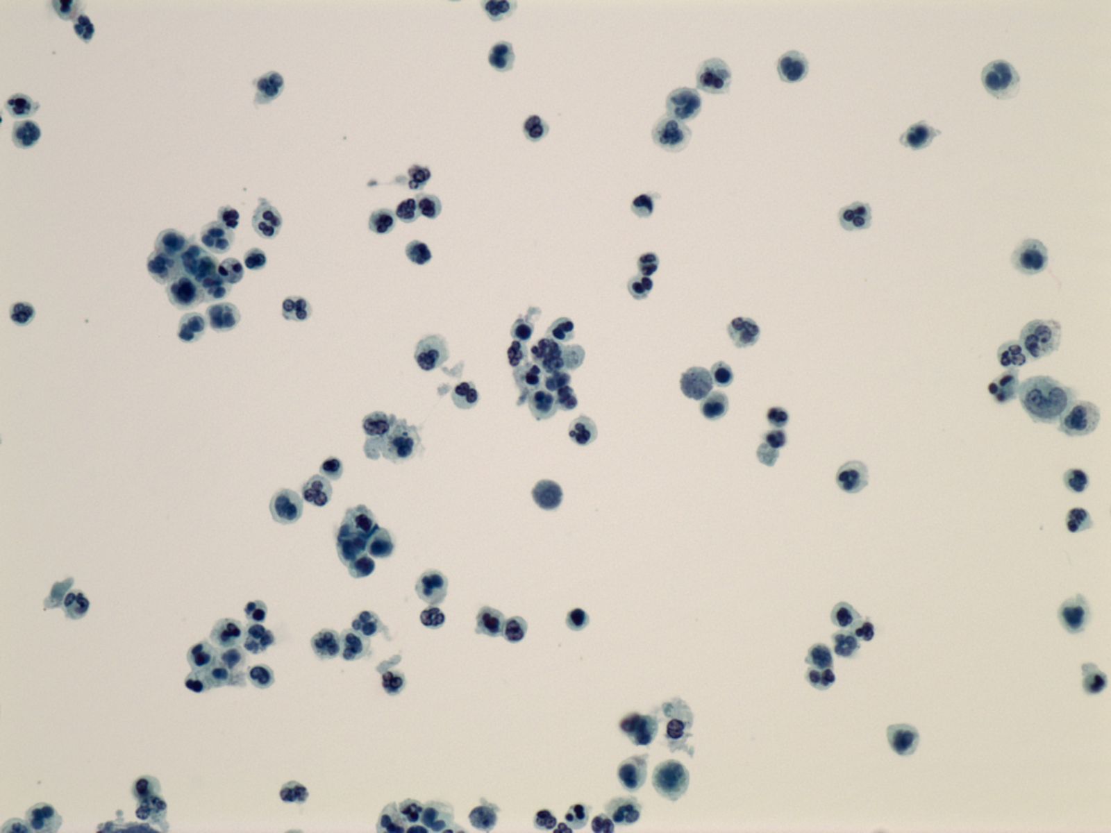 Cytology specimen from the lung.