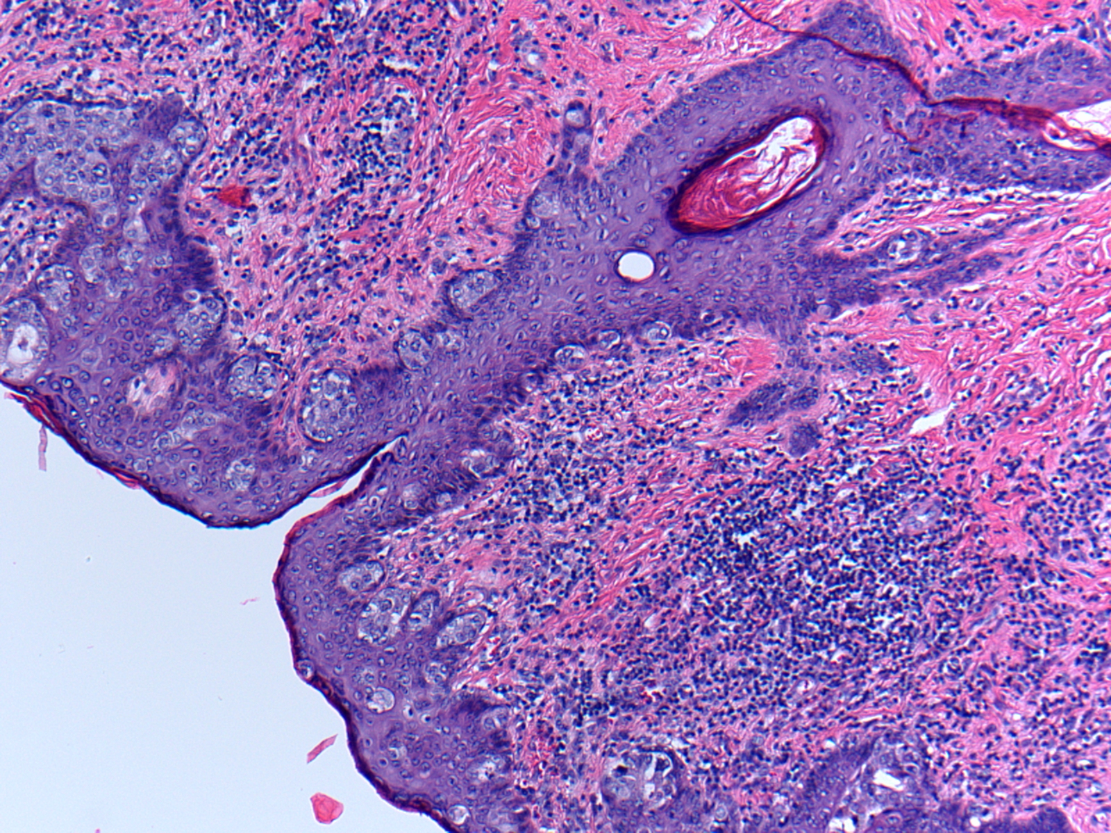 Microscopic image of a breast lesion.
