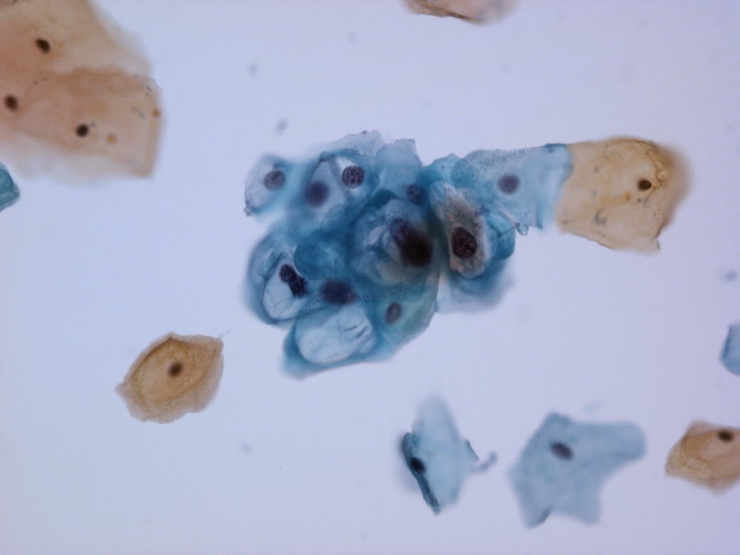 Cervical cytology specimen.