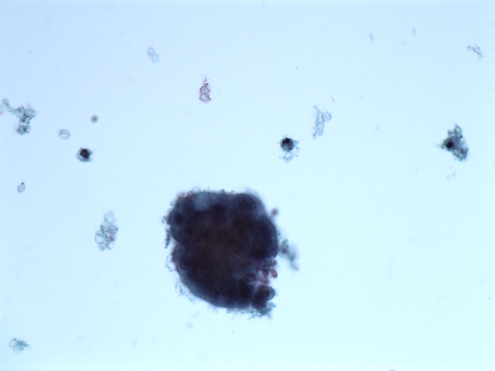 Cervical cytology specimen.