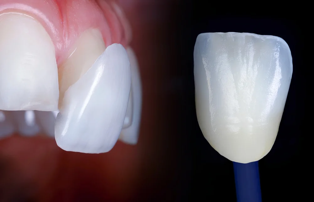 veneers