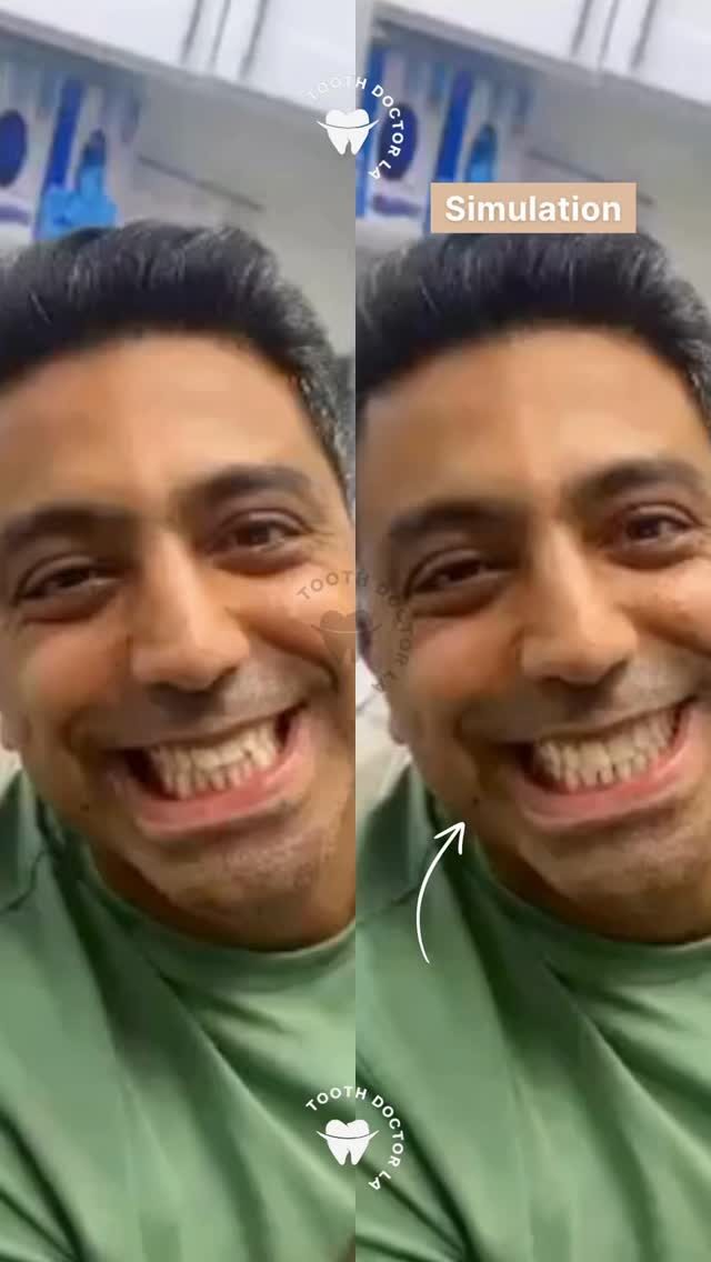 Invisalign smile simulation preview at Tooth Doctor LA