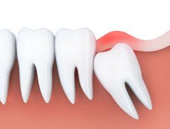 X-ray showing impacted wisdom teeth