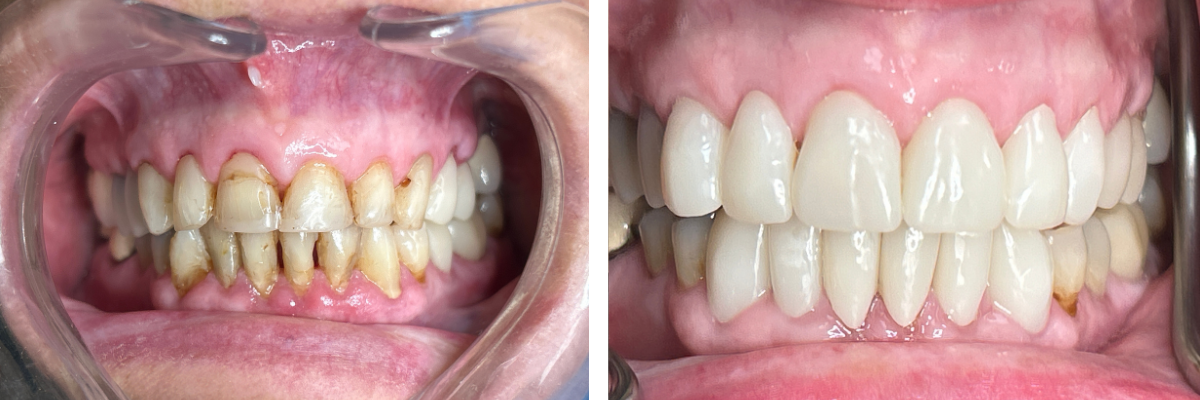 Before and after custom veneers for a brighter, more youthful smile