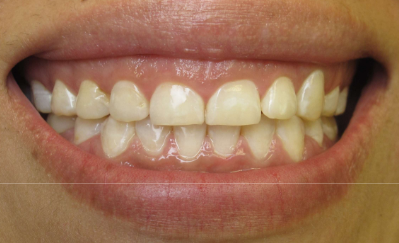 Before — Premium Smile Care smile transformation