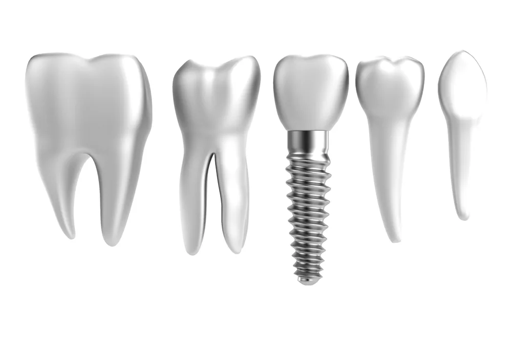 dental implants price in laguna niguel