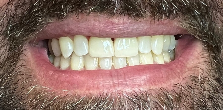 Dental Veneers — after treatment at Tooth Doctor LA