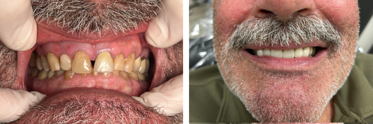 Before and after custom porcelain veneers — worn, uneven teeth restored