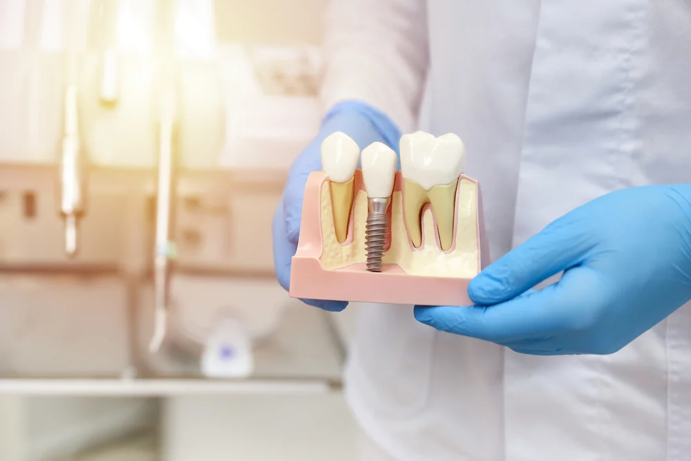 Exploring the Comprehensive Benefits of Dental Implants