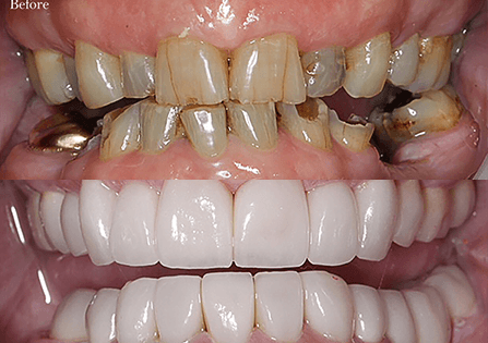 Dental Veneer