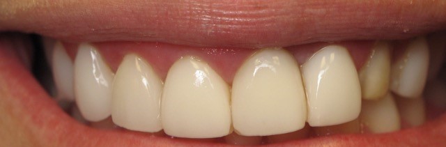 After — Premium Smile Care smile transformation