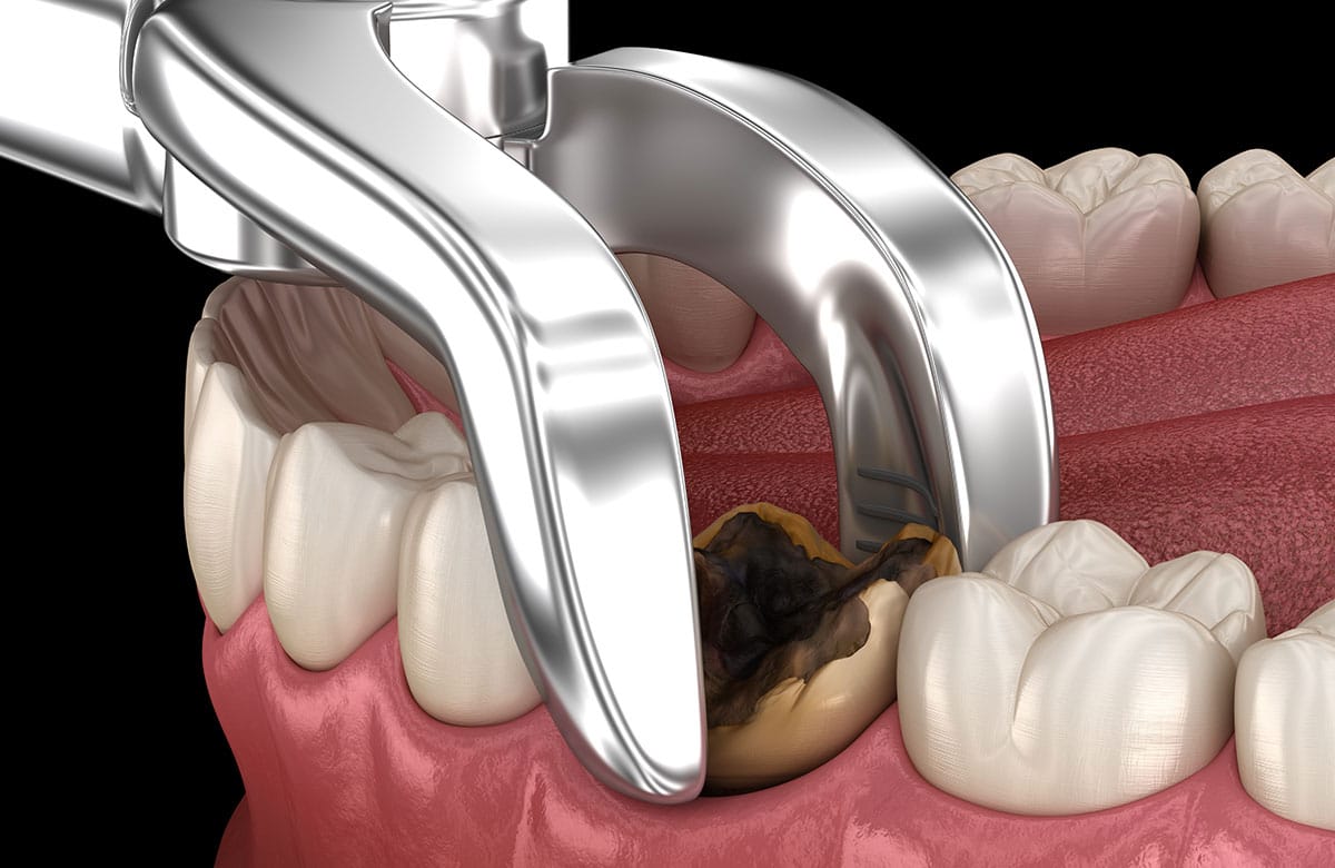 Tooth extractions at Premium Smile Care in Riverside, CA