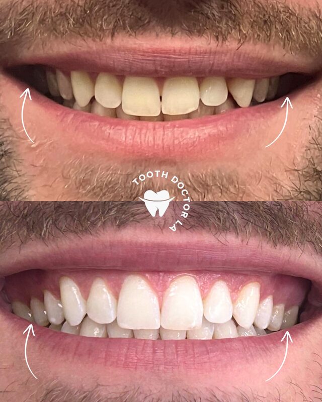 A fuller, wider smile achieved with Invisalign