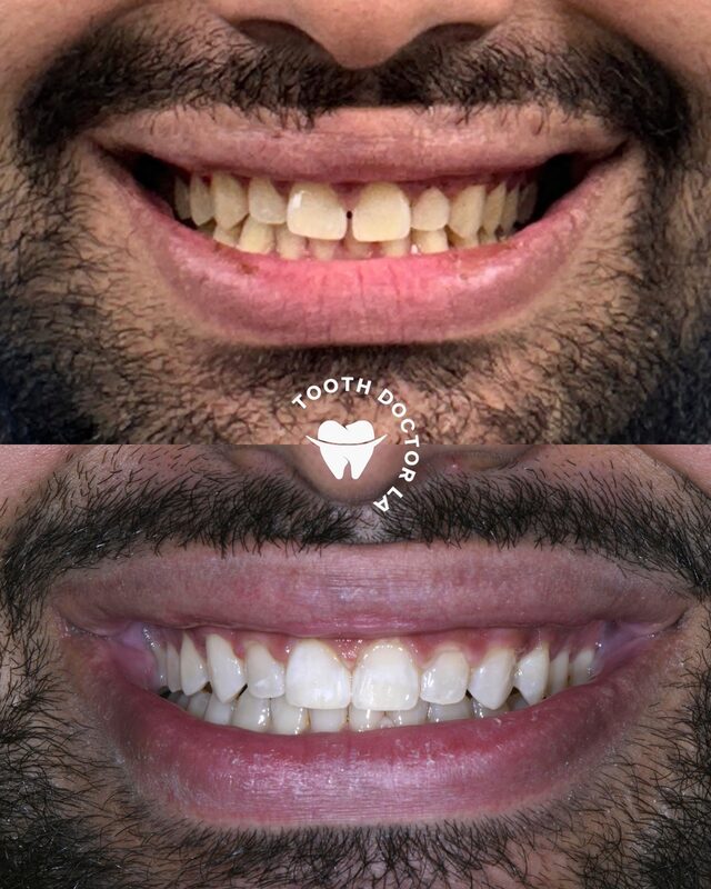 Invisalign and teeth whitening before and after