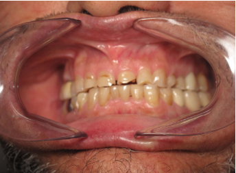 Before — Premium Smile Care smile transformation