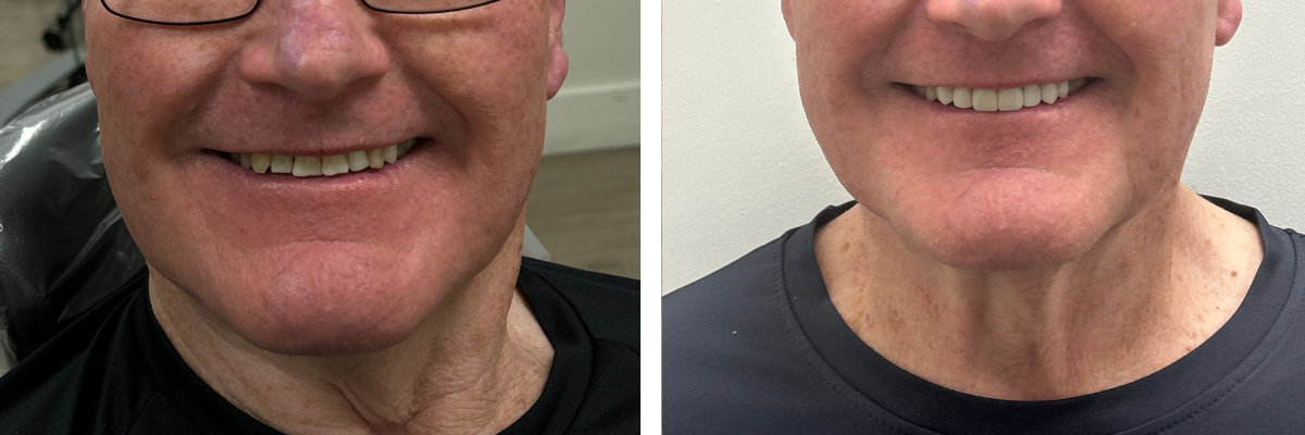 Before and after porcelain veneers restoring a patient’s confidence