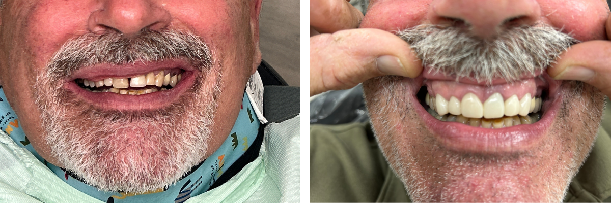 Before and after smile transformation from a patient at Laguna Heights Dental in Laguna Niguel CA
