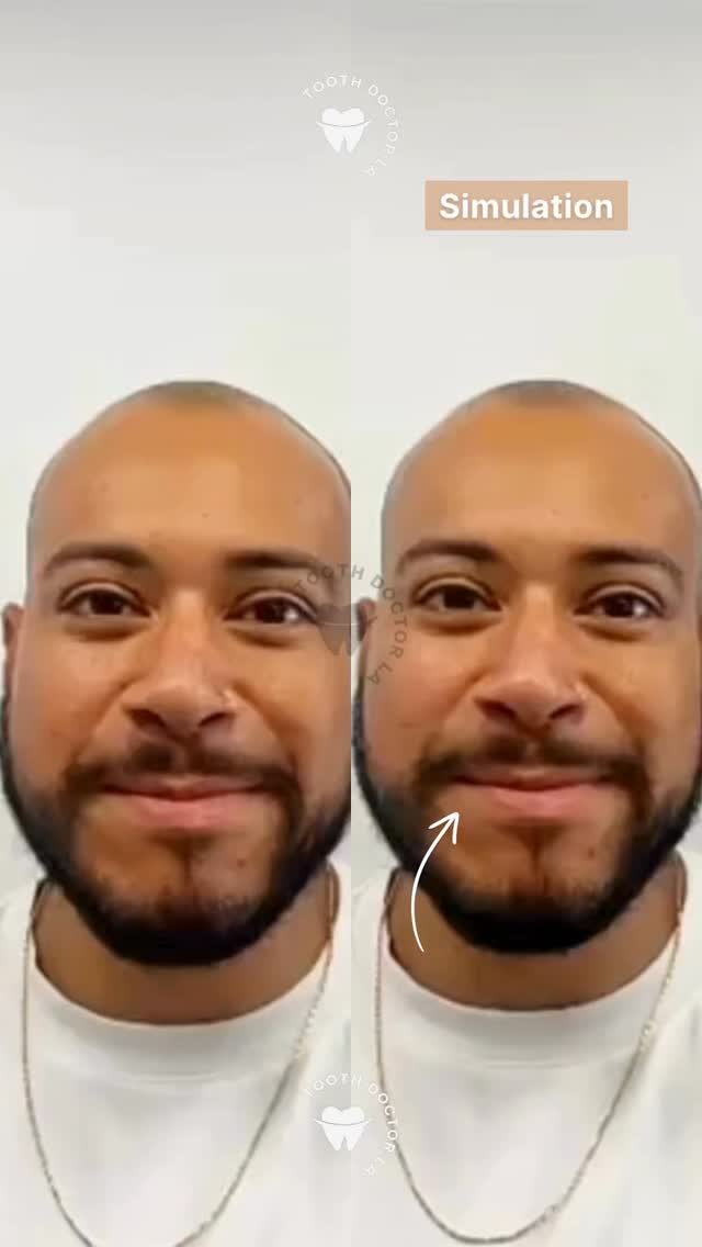 Digital smile simulation video preview