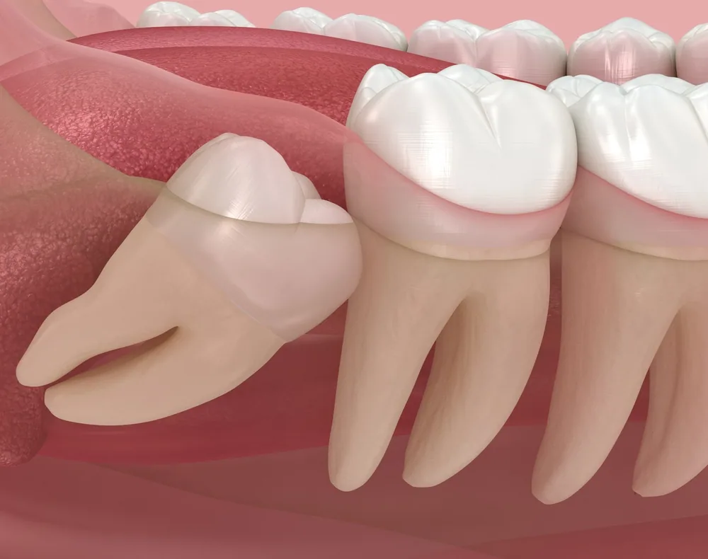 wisdom tooth extraction cost in laguna niguel ca