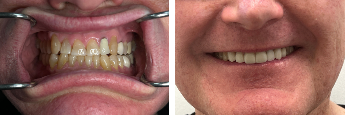 Before and after smile makeover with porcelain veneers by Dr. Nazita Gaff