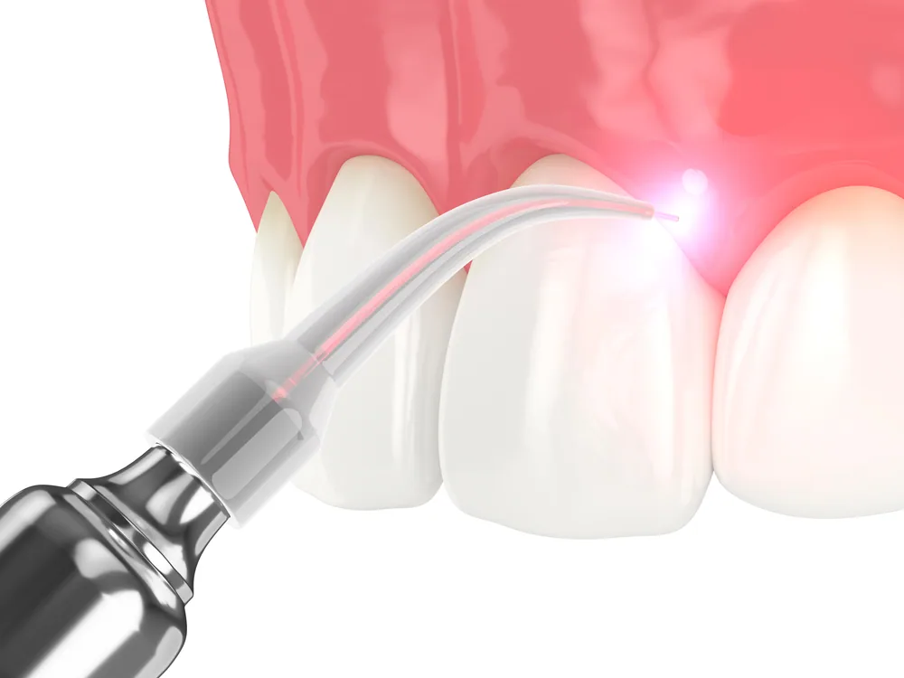 laser treatment laguna niguel ca