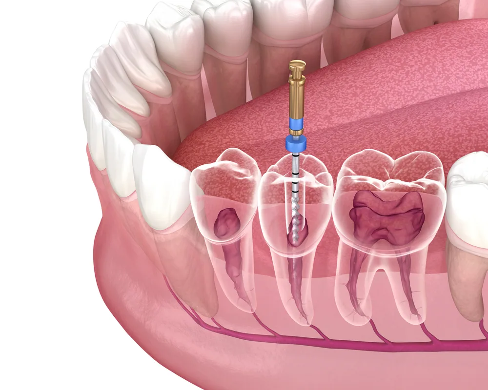 Dentist using laser-assisted technology during a root canal procedure at Laguna Heights Dental