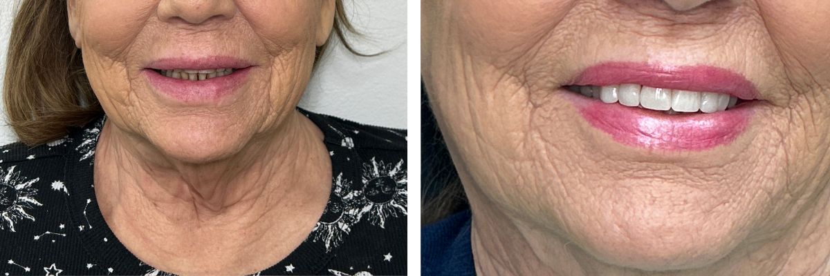 Before and after natural looking porcelain veneers in Laguna Niguel CA
