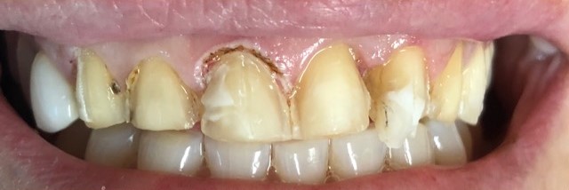 Before — Premium Smile Care smile transformation
