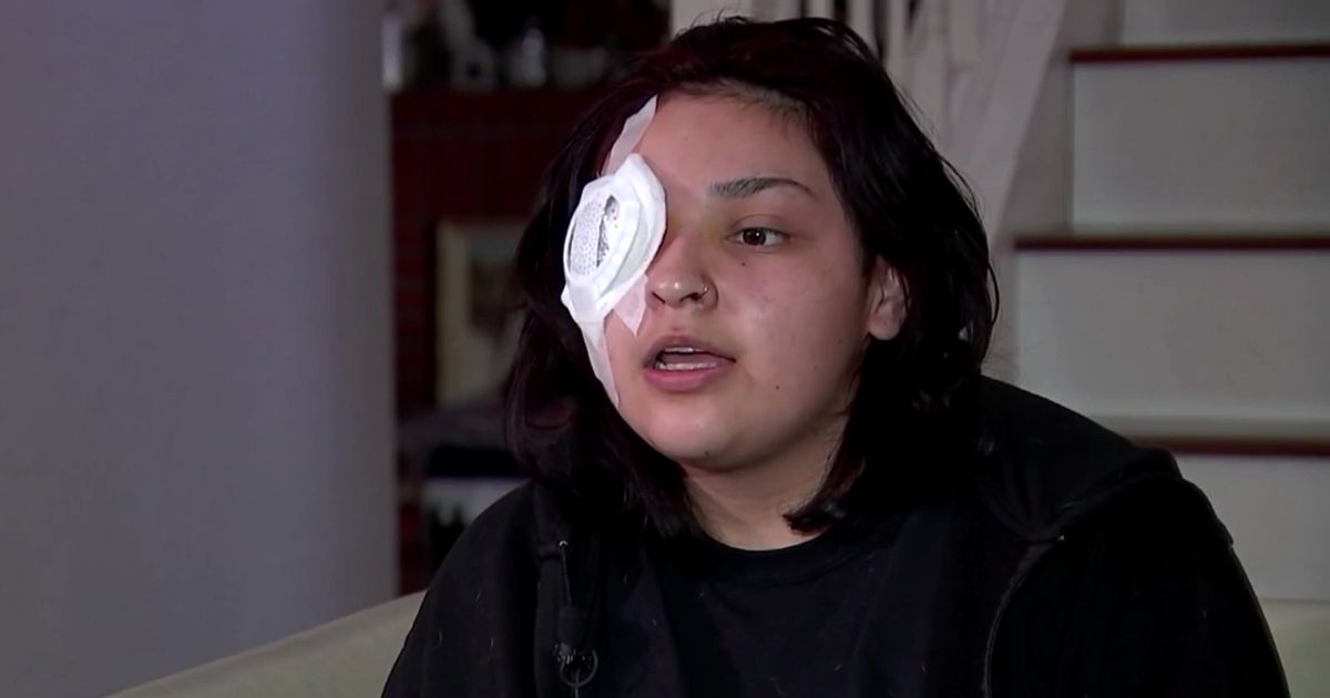 fast-food-worker-loses-eye-habit-burger-grill