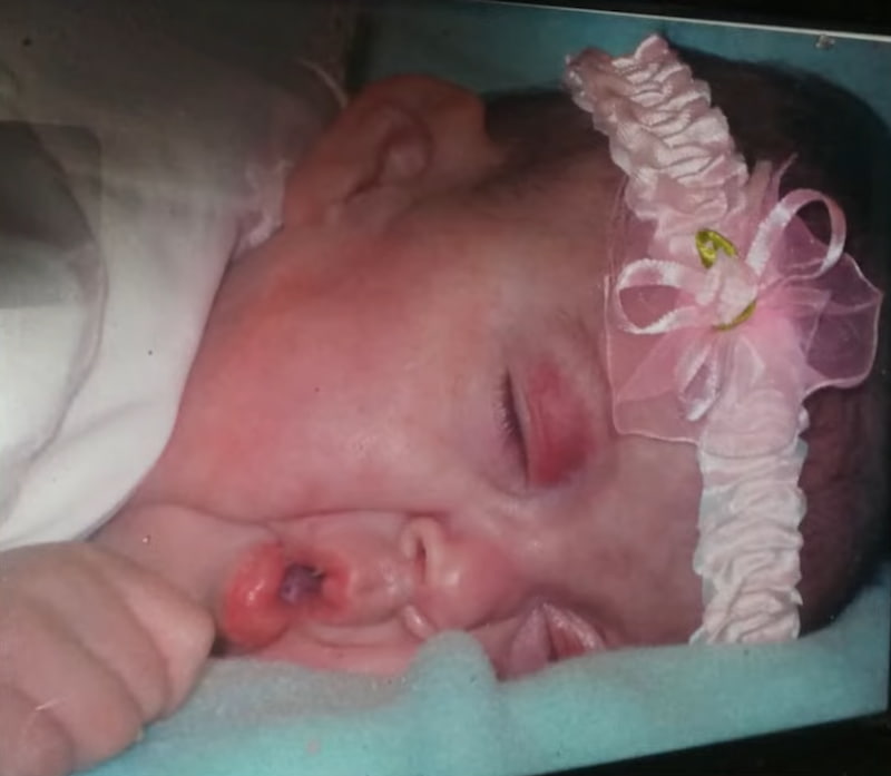 miracle baby born at 25 weeks