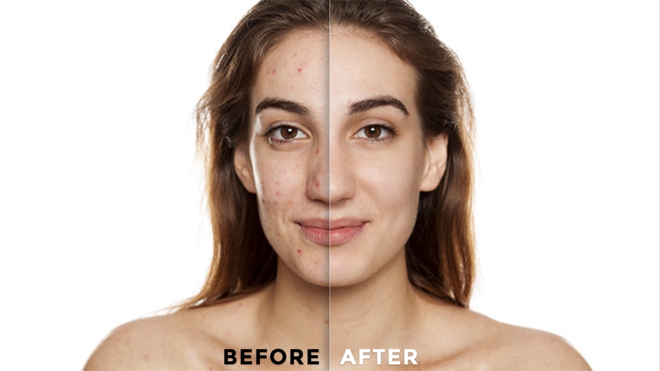 Jasa photoshop edit foto sebelum dan sesudah, edit wajah, hapus jerawat, edit foto online