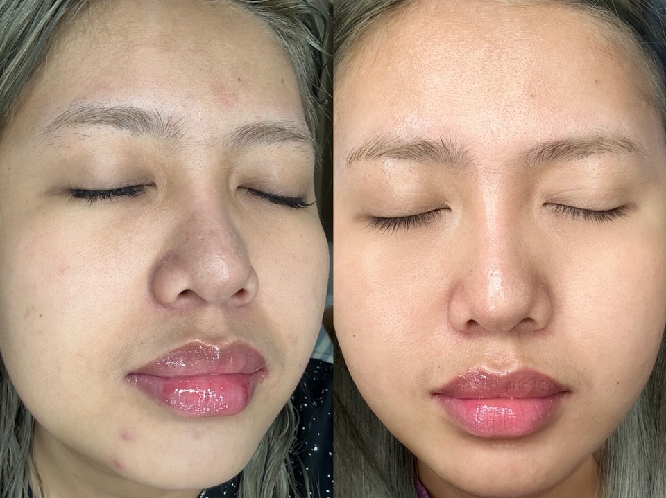 เขียนรีวิว - Review Lemon,IG,Before+After - 2